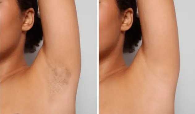 Hair-laser-removal-UM