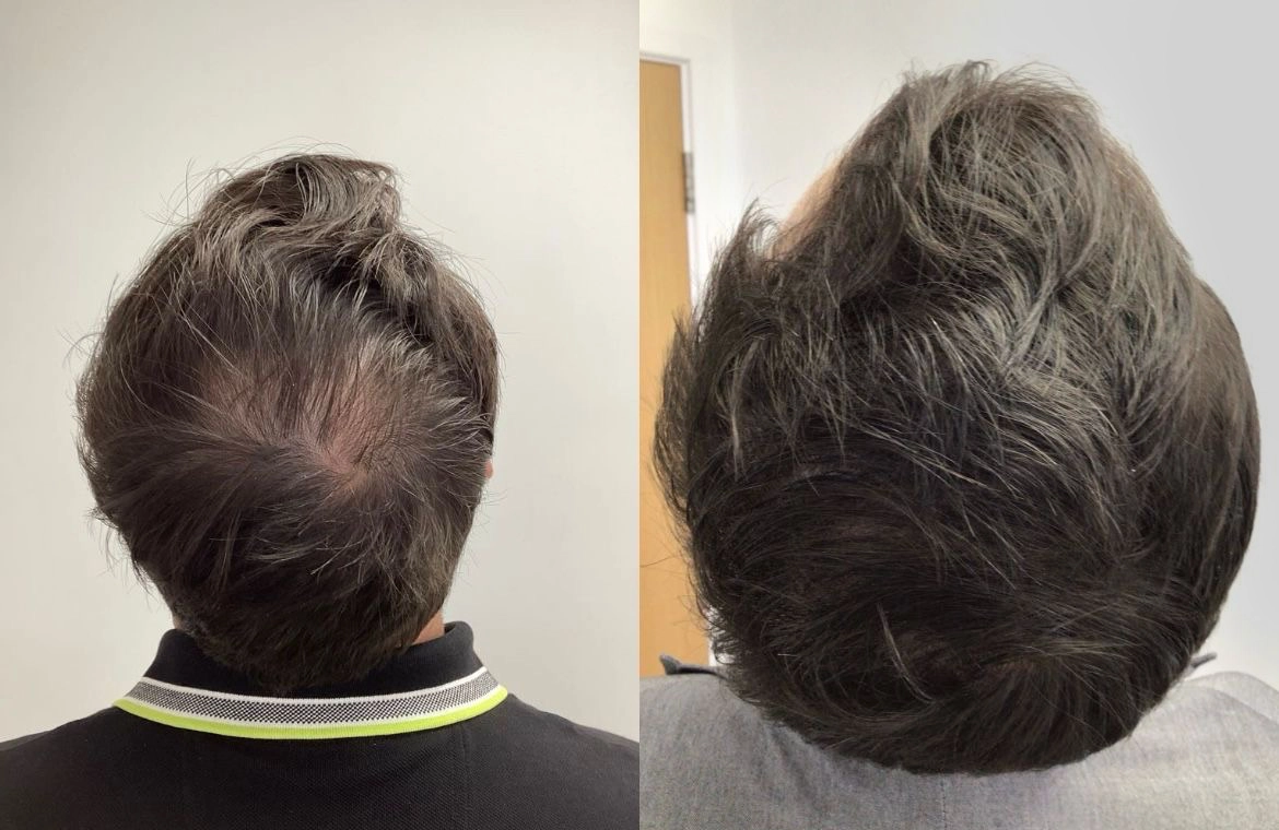 Non-Surgical-Hair-Treatment-Before-And-After-2