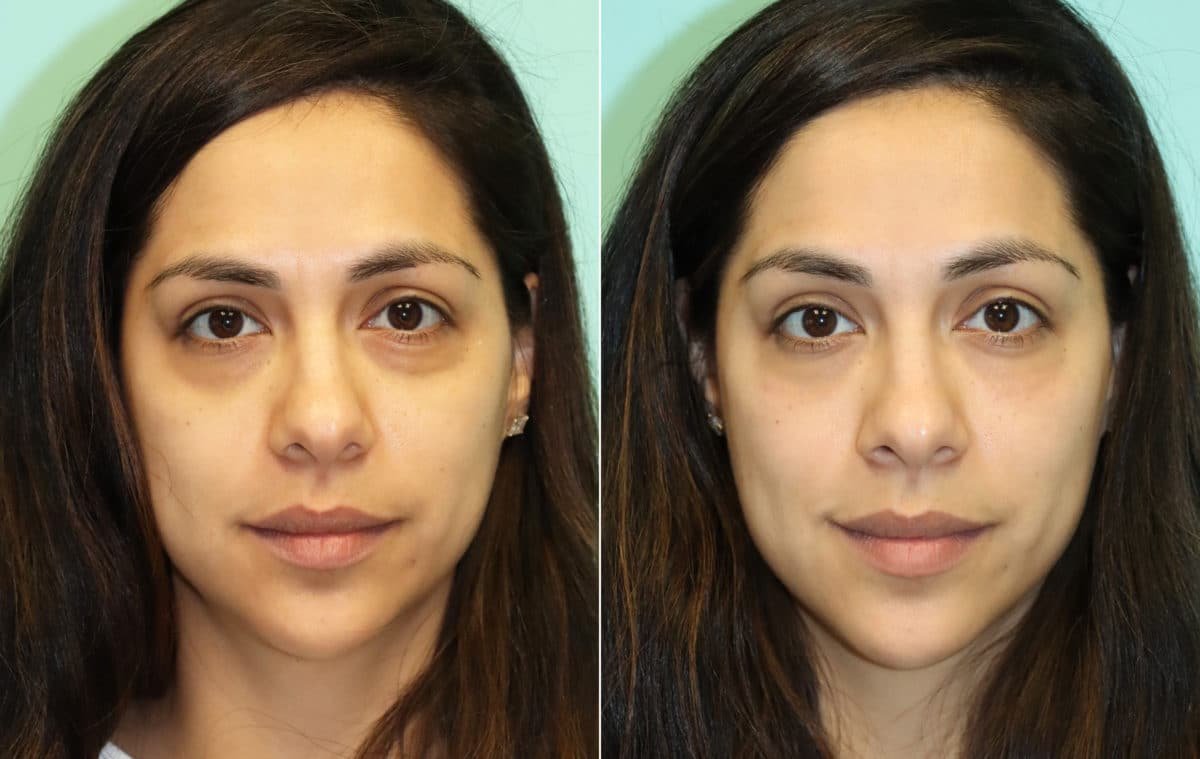 Under Eye Filler Dubai