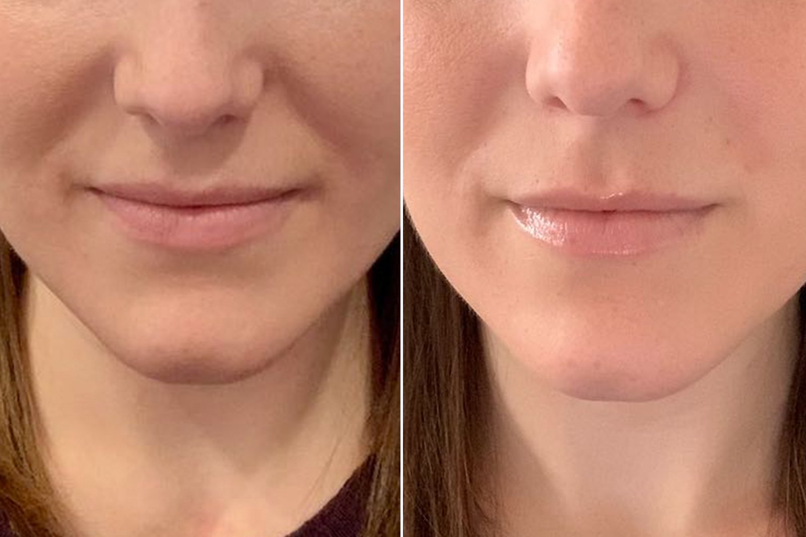 Nasolabial Filler Dubai