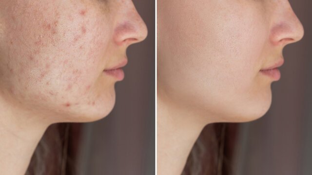 Acne Peel Dubai