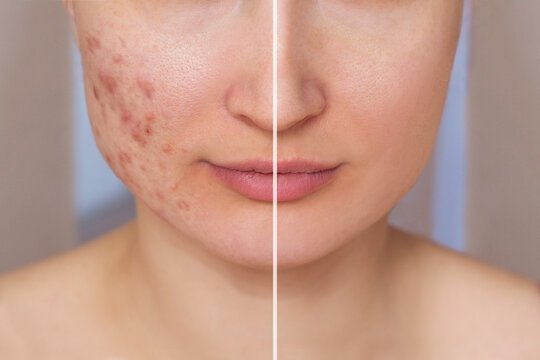 Peptide Pen Scarring Dubai