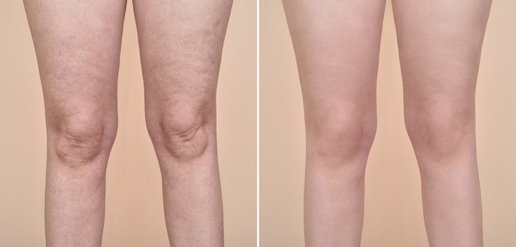 Cellulite Treatment Dubai