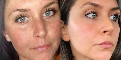 Laser Pigmentation Dubai