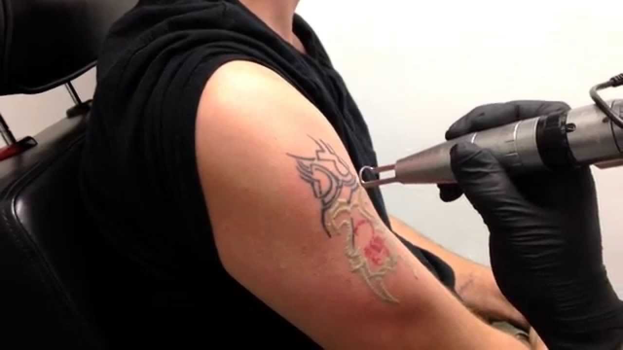 Laser Tattoo Removal Dubai