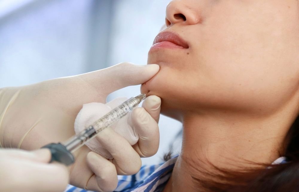 Jawline Filler