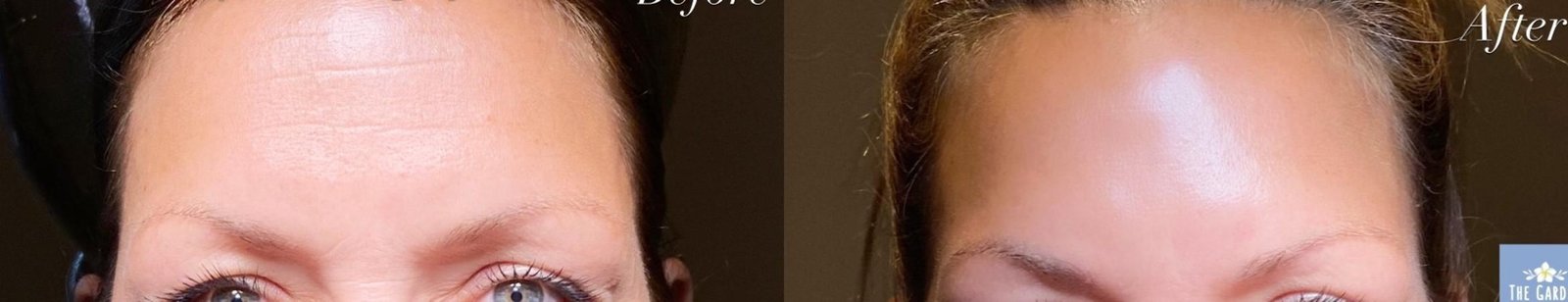 Botox before and after forehead treatment