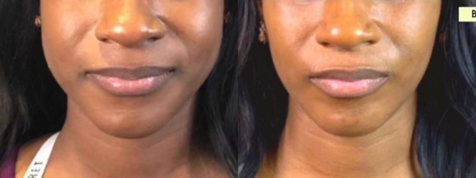 Botox before and after jawline slimming