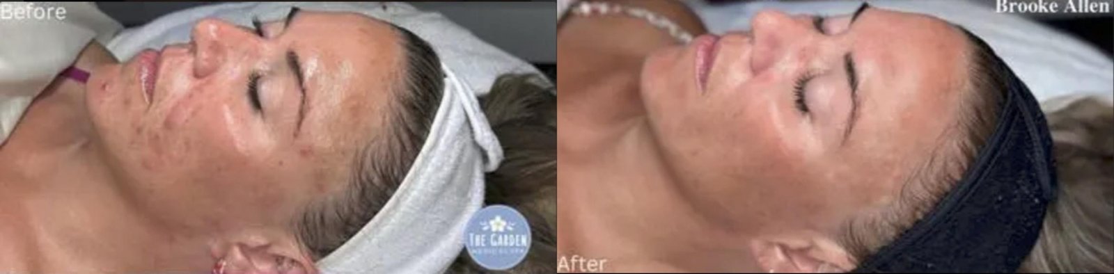 Chemical peel before and after acne treatment
