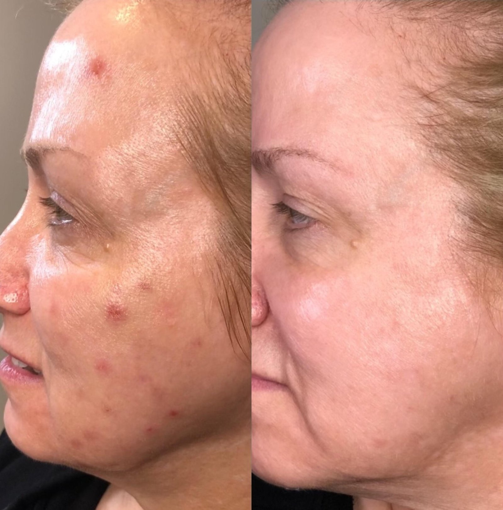 Chemical peel before and after skin treatment