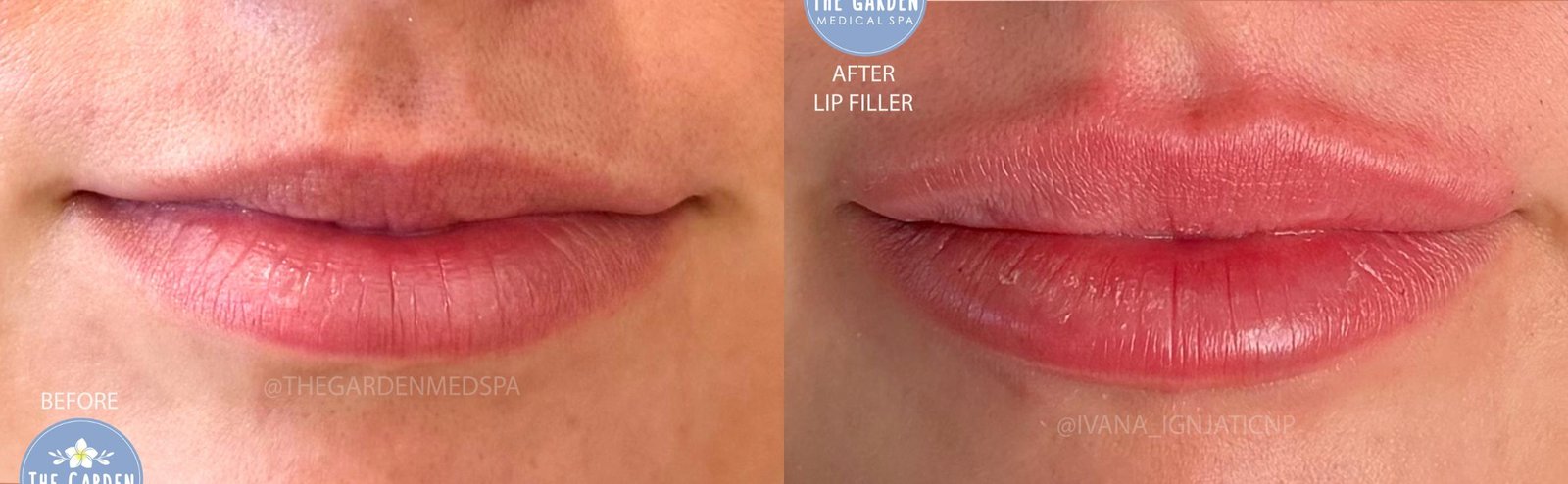 Dermal Filler Before After 2 - Lip Filler