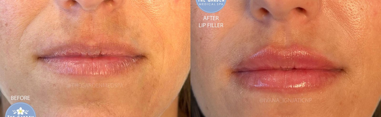 Dermal Filler Before After 1 - Lip Filler