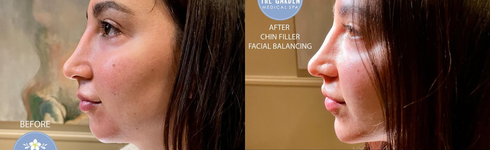 Dermal Filler Before After 4 - Chin Filler