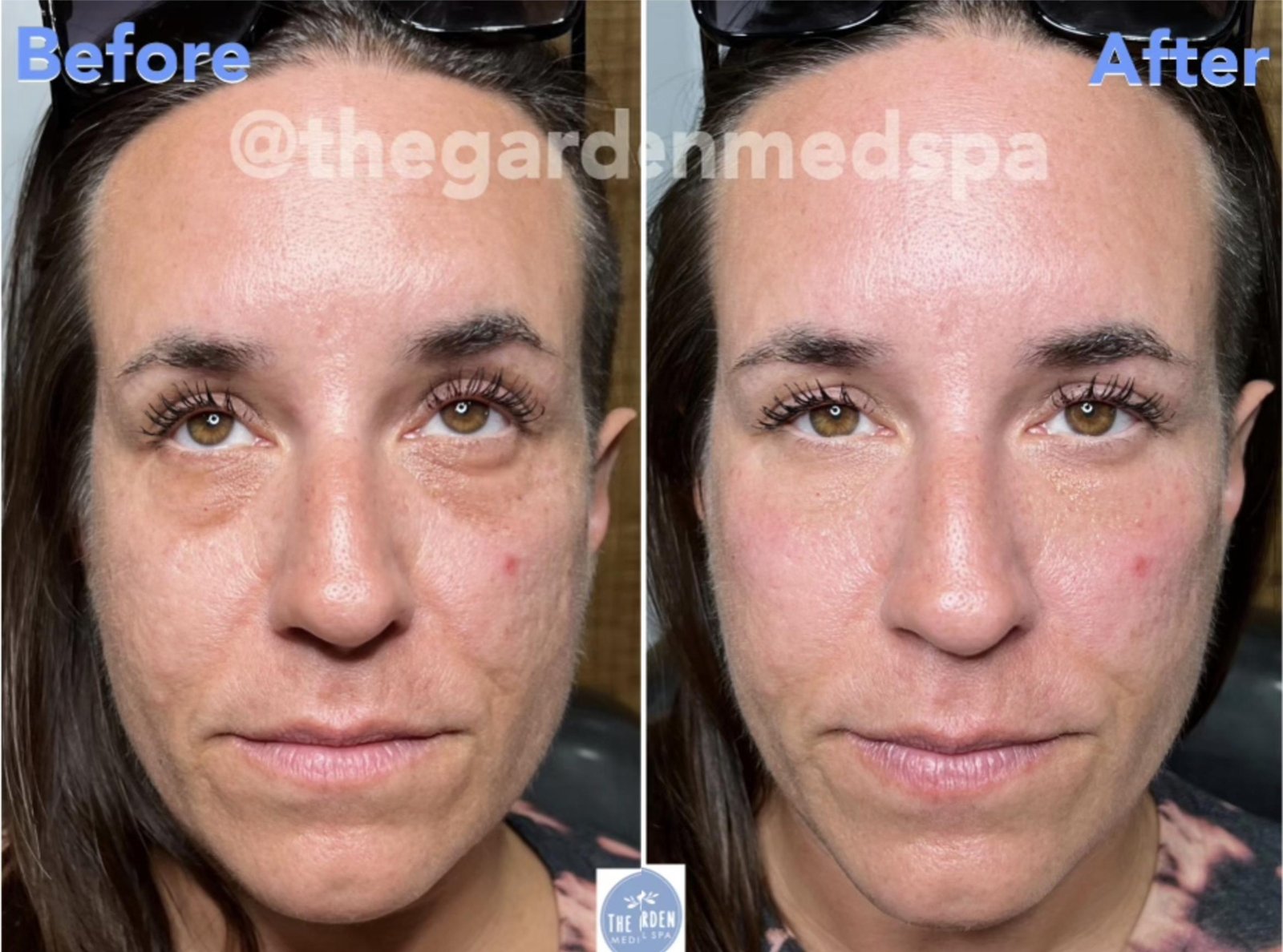 Dermal Filler Before After 3 - Under Eye Filler