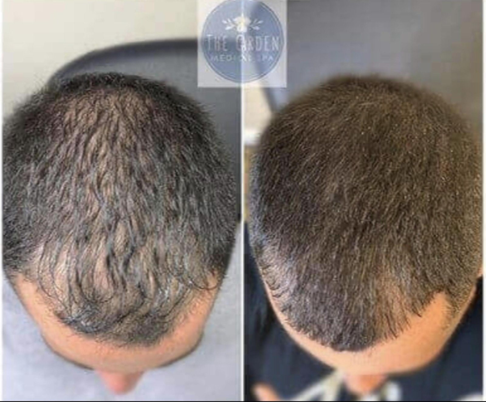 PRP hair loss treatment before and after