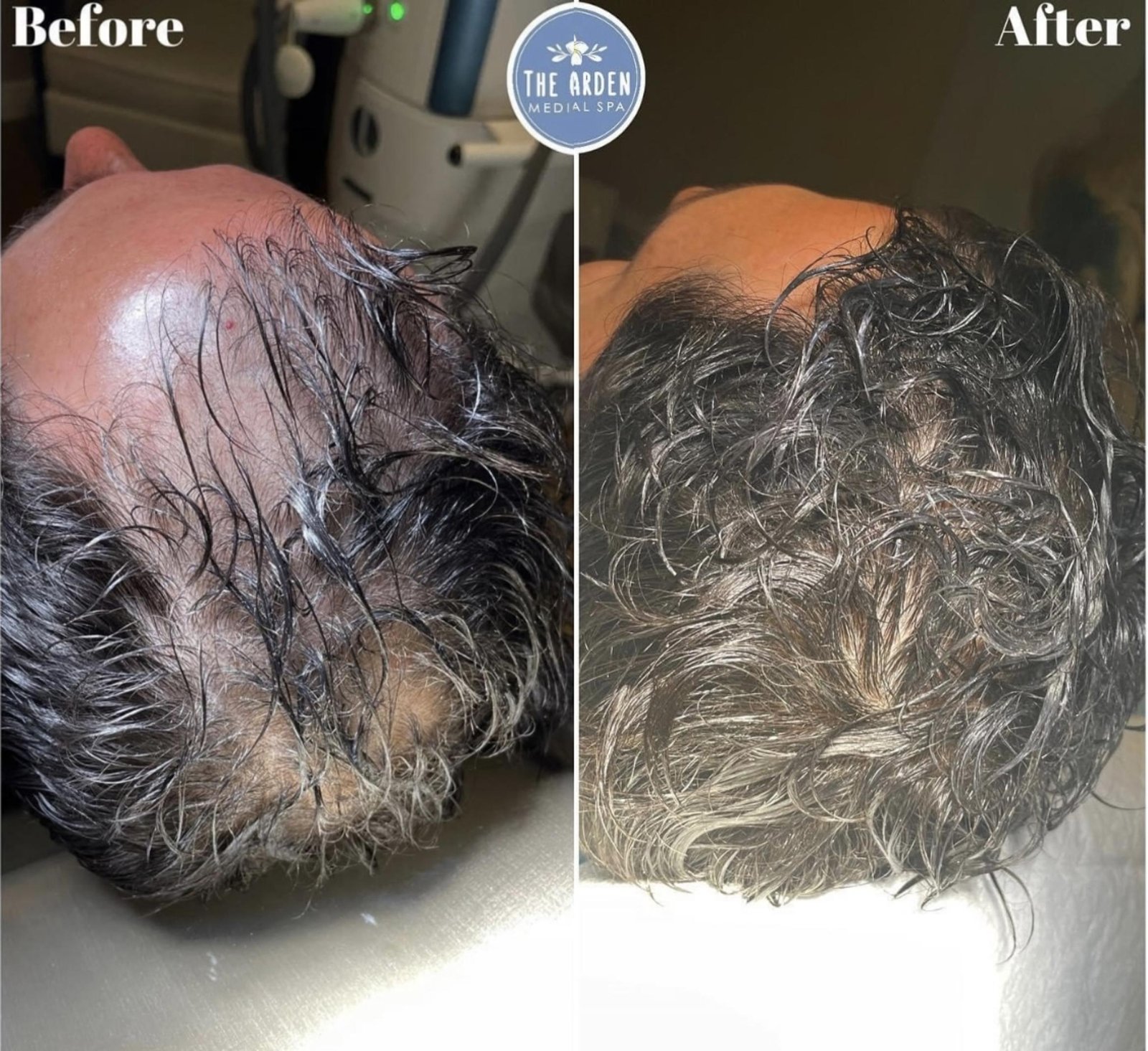 PRP hair restoration before and after