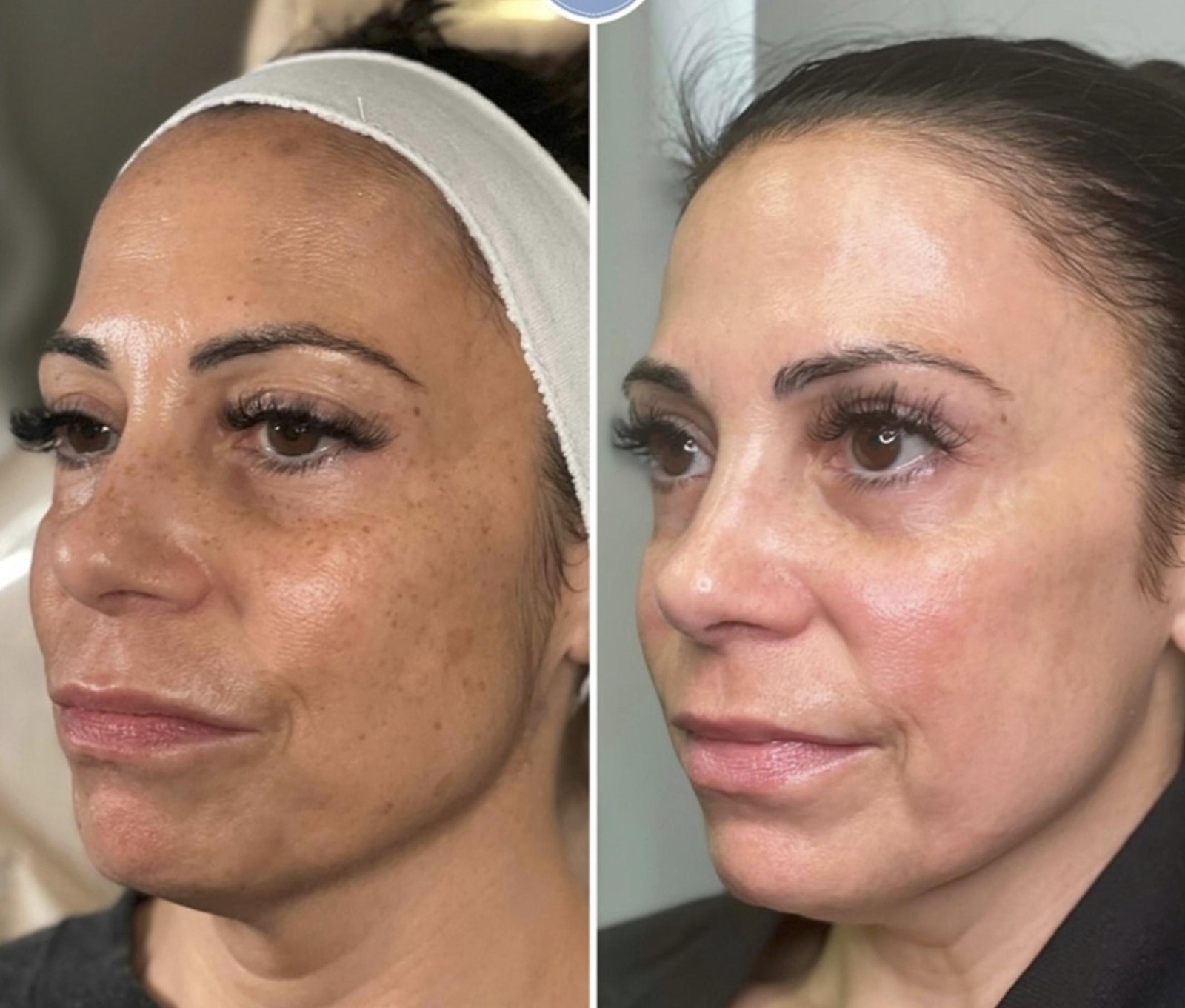 Peptide Pen Before After 3 - Skin Tone