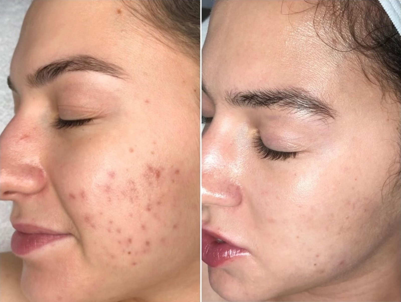 Peptide Pen Before After 4 - Anti Ageing