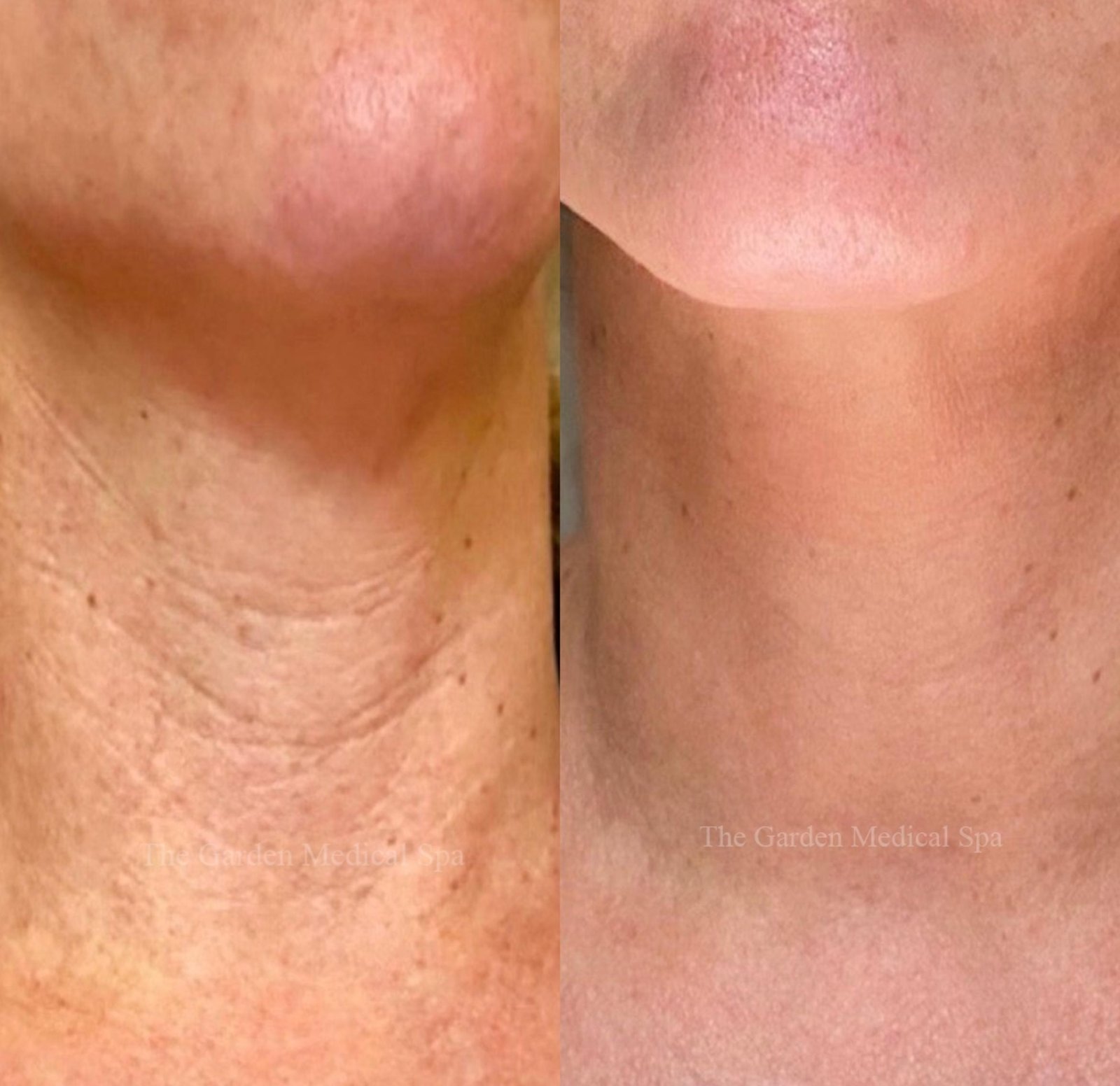 Mesotherapy before and after skin rejuvenation