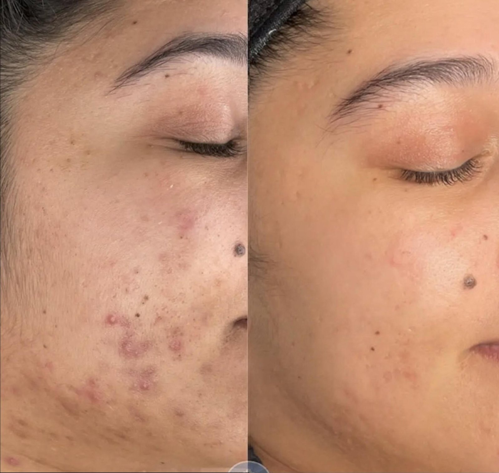 Peptide Pen Before After 1 - Acne Scars
