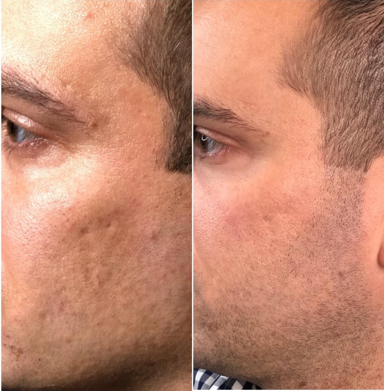 Peptide Pen Before After 2 - Skin Texture