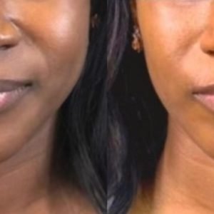 Botox before and after jawline slimming