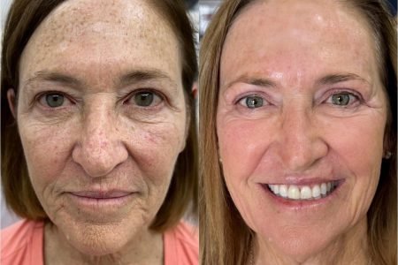 Carbon CO2 Laser Peel Before After Case 147