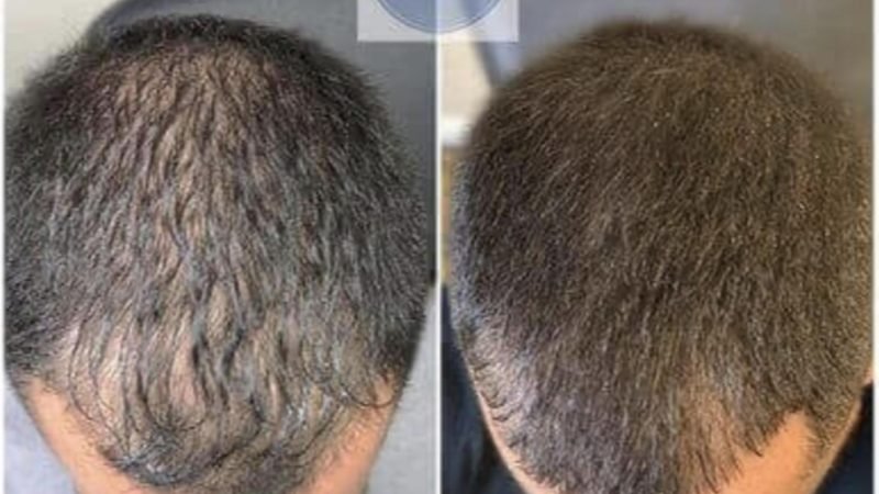PDRN Hair Restoration Before After 1
