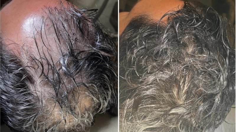 PDRN Hair Restoration Before After 2