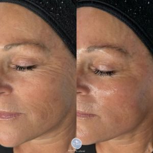 HydraFacial before and after skin hydration