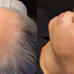 HydraFacial before and after skin rejuvenation