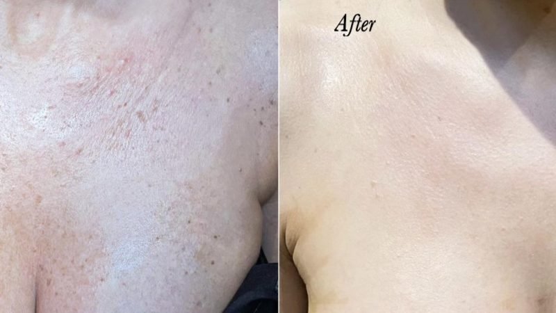 PDRN Pigmentation Before After 1