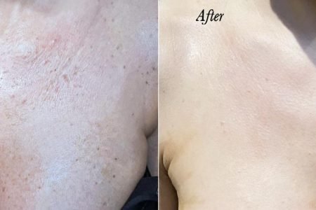 IPL Photofacial Pigmentation Sun Damage Before After Case 21