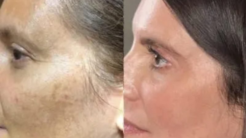 PDRN Pigmentation Before After 2