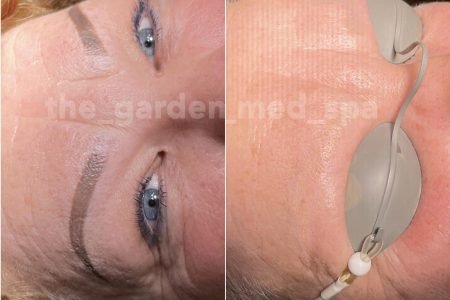 Laser Tattoo Removal Eyebrow Before After Case 124