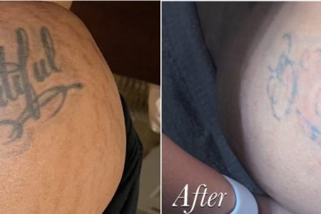 Laser Tattoo Removal Before After Case 125