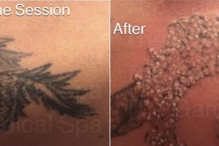 Laser Tattoo Removal Before After Case 129