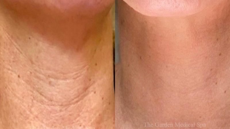 PDRN Skin Glow Before After 2