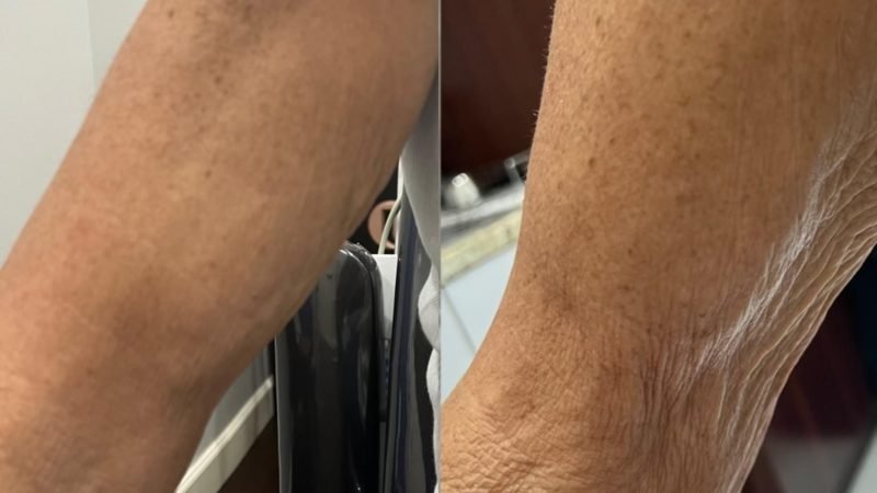 PDRN Skin Glow Before After 1