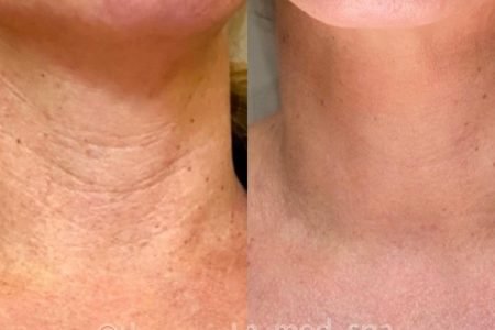 Laser Hair Removal Smooth Skin Before After