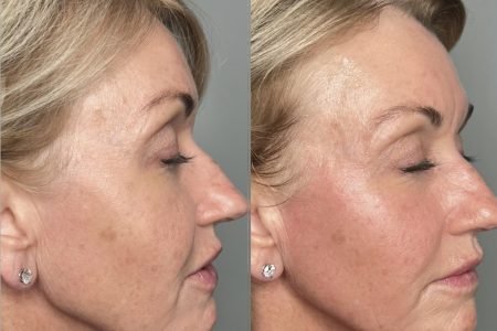 Laser Hair Removal Skin Result Before After