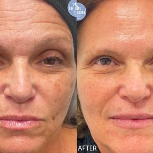 Body sculpting before and after treatment
