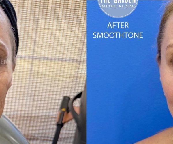 Body Sculpting SmoothTone Before After Case 226