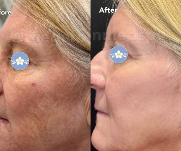 Body Sculpting SmoothTone Before After Case 233