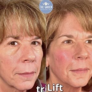 NAD Therapy Before After 4