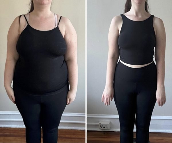 Body Sculpting Weight Loss Before After Case 196